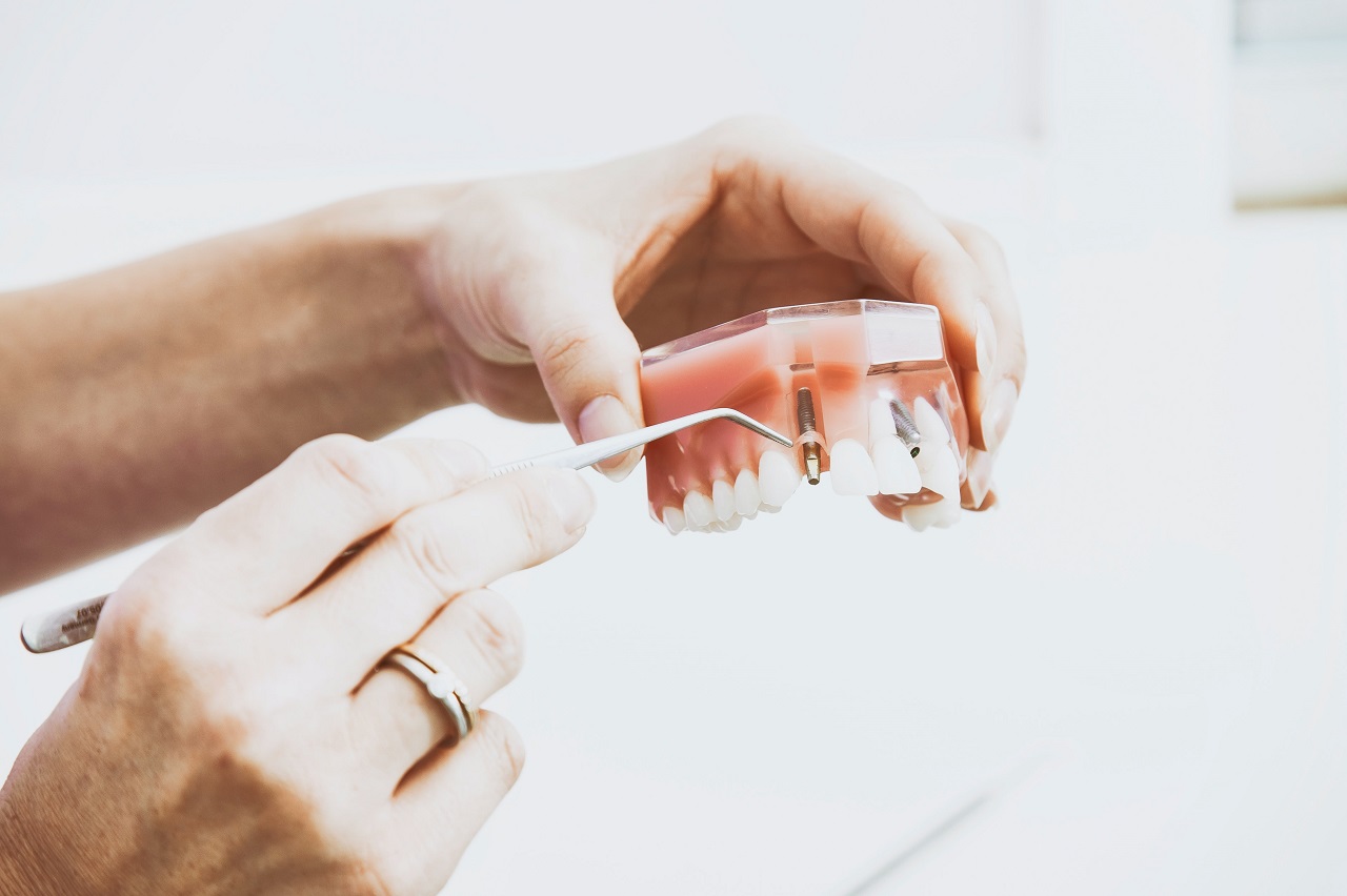 Czym są licówki i czy warto je założyć na zęby?